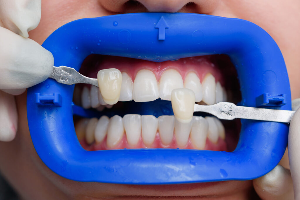 carillas dentales