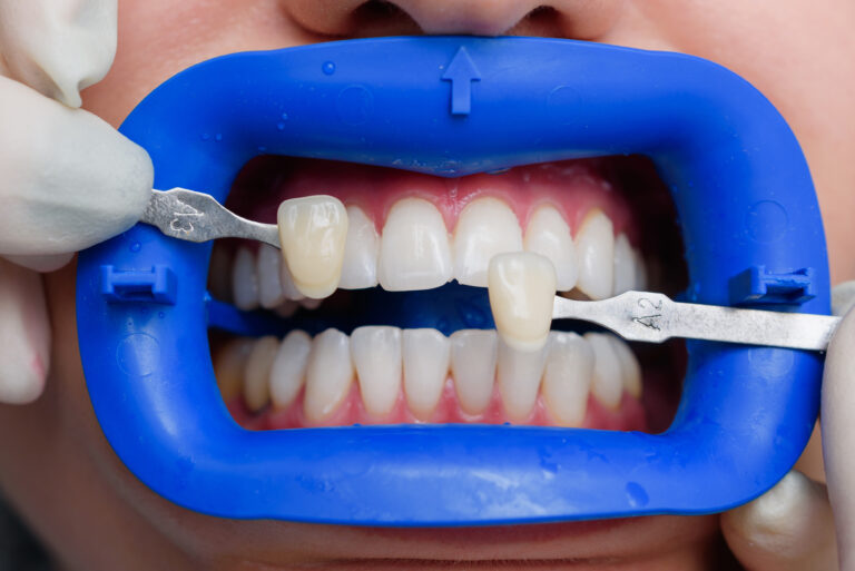 carillas dentales
